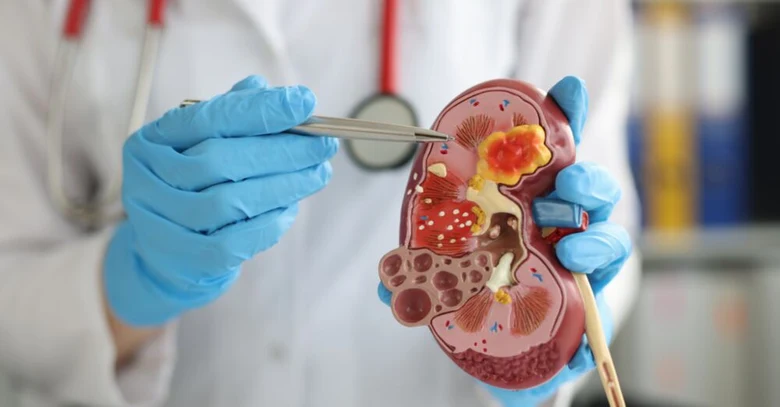 Lékař ukazuje na model ledviny s nástroji pro diagnostiku bolesti.