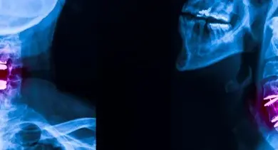 Rentgen krční páteře s implantáty po operaci radikulopatie.