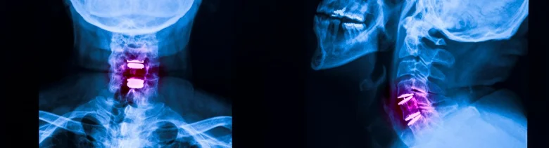 Rentgen krční páteře s implantáty po operaci radikulopatie.