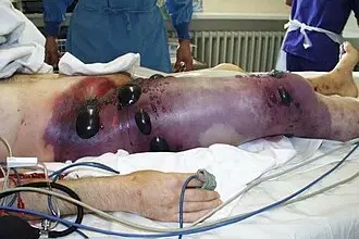 Pacientova noha po amputaci s otevřenými ranami na lůžku.