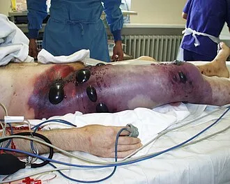 Pacientova noha po amputaci s otevřenými ranami na lůžku.