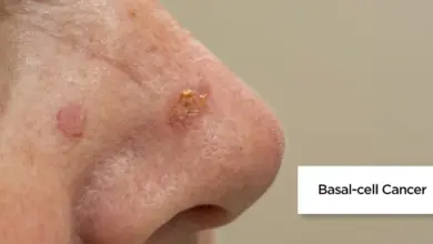 Bazaliom na kůži nosu – typické příznaky bazálního buněčného karcinomu.
