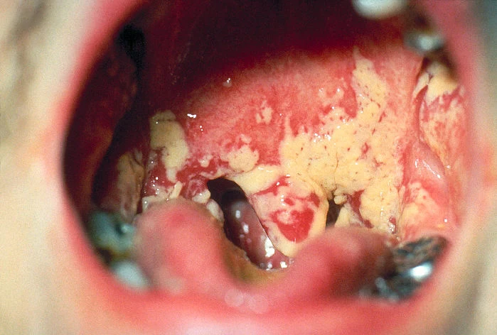 Oral candidiasis lesions